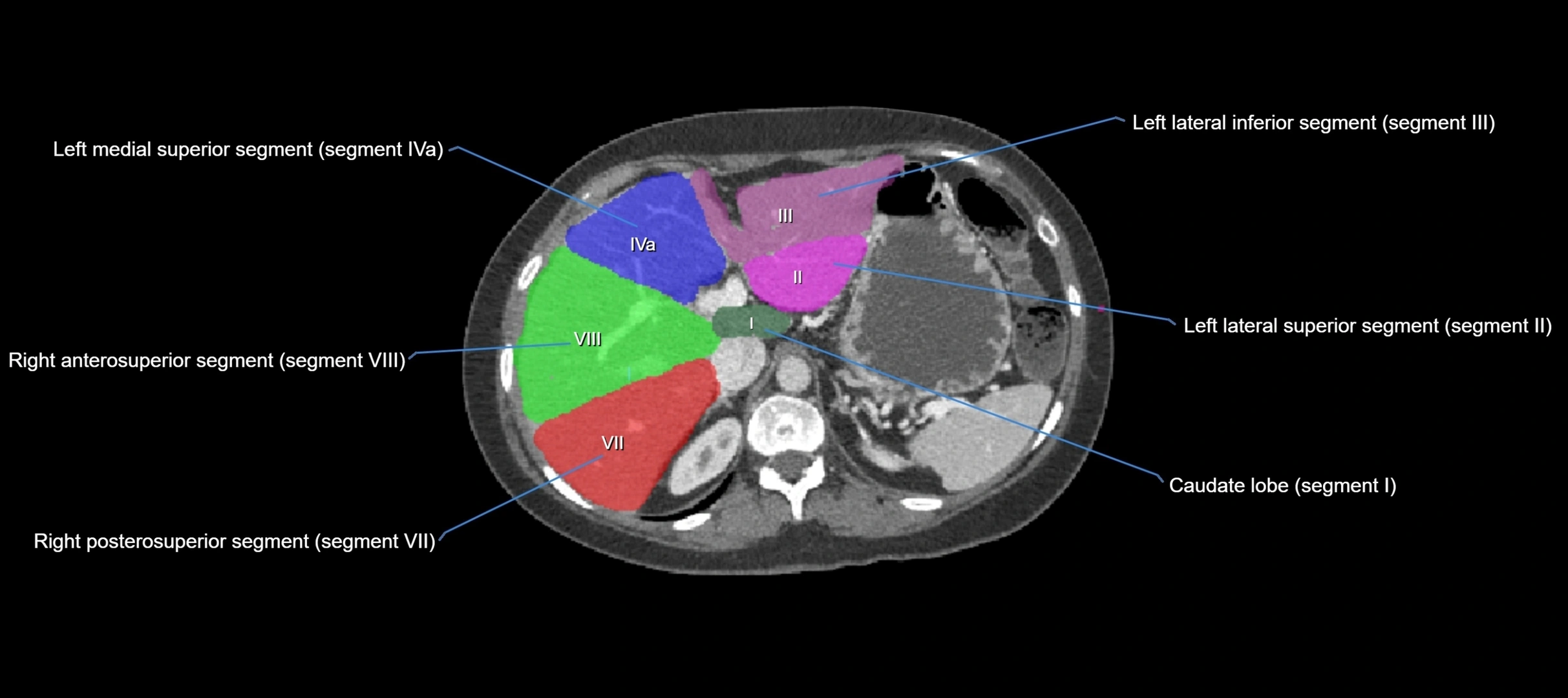 CT liver segments axial cross sectional anatomy labelled image-00049.webp